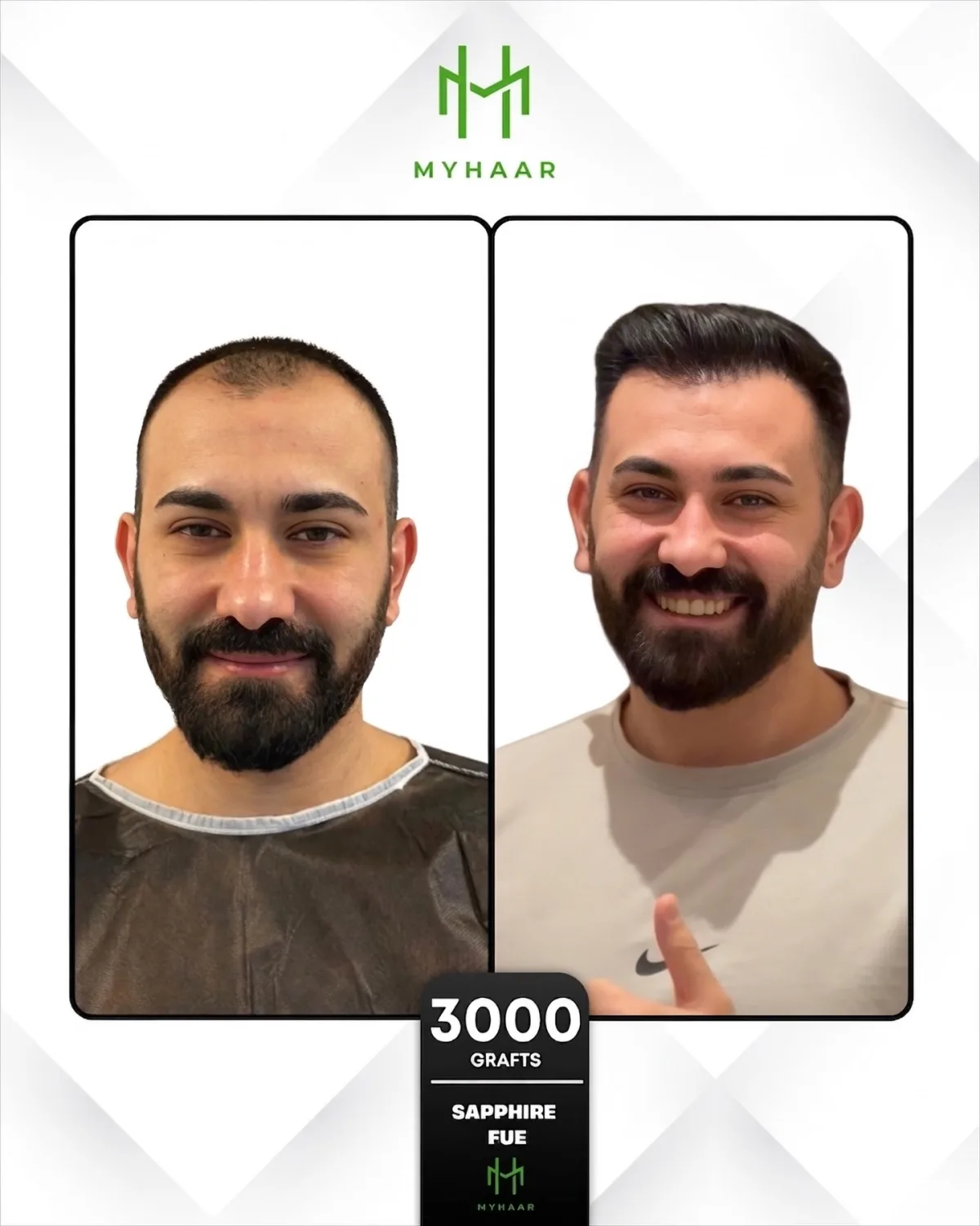 Hair Transplant Turkey vs Netherlands: Turkish Specialists in Den Haag